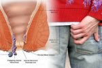 Ngứa hậu môn là bị gì? Cách làm giảm triệu chứng ngứa hậu môn
