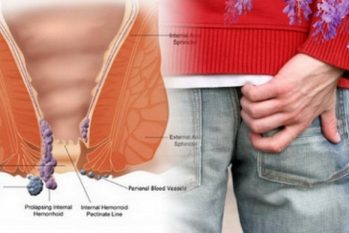 Ngứa hậu môn là bị gì? Cách làm giảm triệu chứng ngứa hậu môn