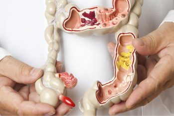 Sa trực tràng là gì ? Dấu hiệu và cách điều trị