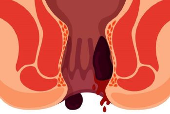 Khi nào chảy máu hậu môn là dấu hiệu ung thư ?