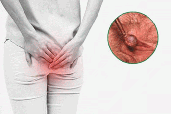 Búi trĩ lòi ra nhưng không đau có nguy hiểm không ?