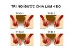 Hình ảnh bệnh trĩ nội và trĩ ngoại qua từng giai đoạn