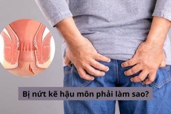Nứt hậu môn và các dấu hiệu nhận biết bệnh sớm