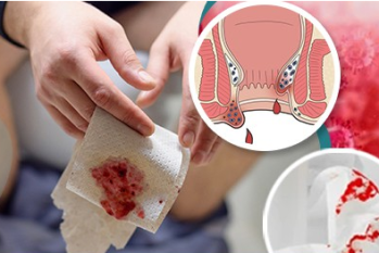 Đi ngoài ra máu tươi là bệnh gì ?