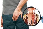 Rò hậu môn là gì? Cách phòng tránh như thế nào?