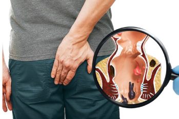 Rò hậu môn là gì? Cách phòng tránh như thế nào?