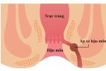 Áp xe hậu môn: Triệu chứng và cách xử lý kịp thời