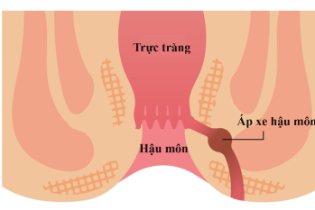 Áp xe hậu môn: Triệu chứng và cách xử lý kịp thời