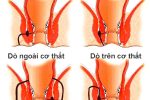 Áp xe hậu môn có nguy hiểm không ?