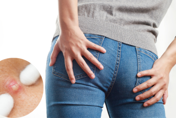 Bí mật ít ai biết về tình trạng nổi mụn nhọt ở hậu môn