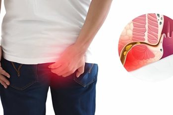 Hậu môn sưng đau có mủ? Cảnh báo trĩ độ nặng