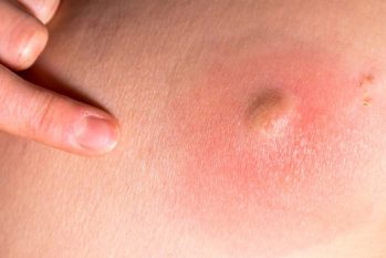 Nổi mụn nhọt ở hậu môn là bệnh gì? Nguyên nhân và cách điều trị