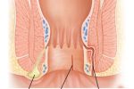 Những biến chứng khôn lường của bệnh rò hậu môn cần biết