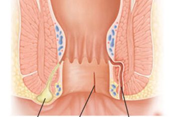 Những biến chứng khôn lường của bệnh rò hậu môn cần biết