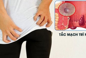 Trĩ ngoại kéo dài: Dấu hiệu cảnh báo bệnh đang chuyển nặng