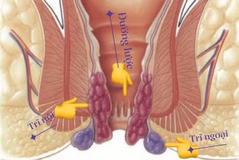 Top phương pháp chữa trĩ ngoại hiệu quả được chuyên gia khuyên dùng
