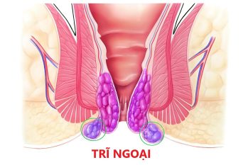 Các phương pháp điều trị trĩ ngoại phổ biến hiện nay