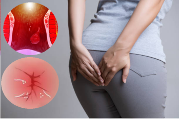 Nguyên nhân gây bệnh ngứa hậu môn có sao không cách điều trị an toàn