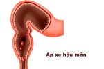 Nguyên nhân bị áp xe hậu môn? Cách điều trị