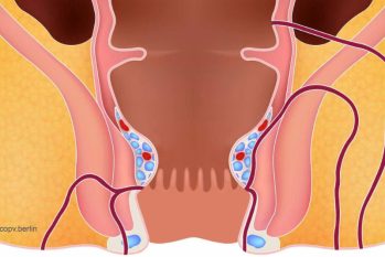 Hậu môn chảy dịch vàng là bị gì ? Khi nào cần đi khám ?
