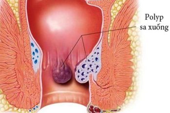 Cách chữa bệnh lòi dom ở người lớn