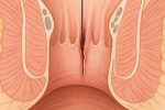 Nứt kẽ hậu môn mãn tính là gì ? Có chữa khỏi không ?