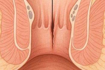 Nứt kẽ hậu môn mãn tính là gì ? Có chữa khỏi không ?