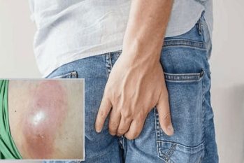 Hậu môn bị sưng đau phải làm sao ?