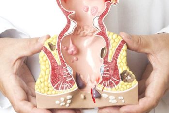 Bệnh trĩ tái phát sau phẫu thuật phải làm sao ?