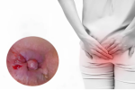 Hình ảnh Thịt và Da thừa ở hậu môn chi tiết ở nam và nữ